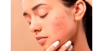 Prisão de ventre e acne. Qual a relação?