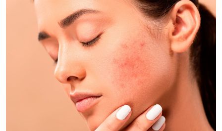Prisão de ventre e acne. Qual a relação?